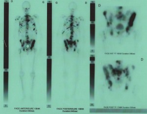 scintigraphie osseuse